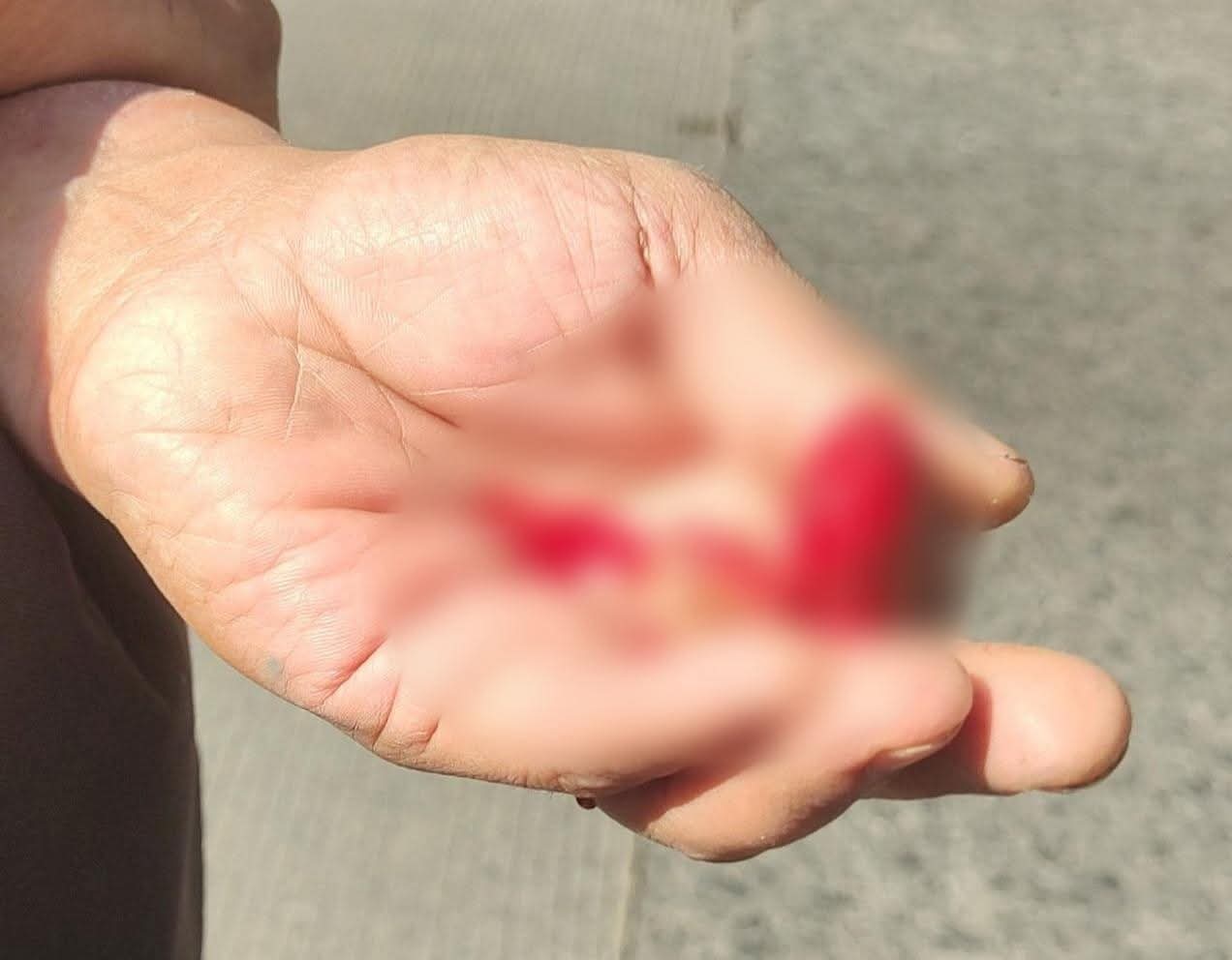 POR ACCIDENTE MOTOCICLISTA PIERDE PARTE DE UN DEDO